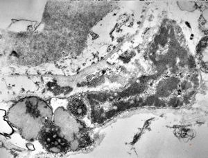 M,71y. | Alzheimer diseaseaccompanied with CADASIL M,71y. | Alzheimer diseaseaccompanied with CADASIL